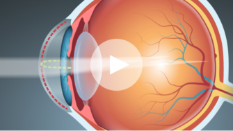 What causes blurry vision animation